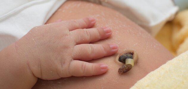 Niemowlę leży z odsłoniętym brzuszkiem i położoną na nim rączką. Brzuszek dziecka pokryty jest złuszczającą się skórą, a jego pępek jest w trakcie procesu gojenia.