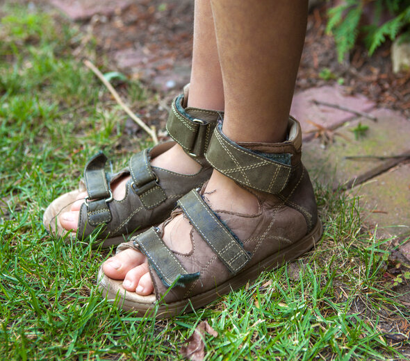 Kilkuletnie dziecko przebywa w ogrodzie. Dziecko w lato chodzi po łące w sandałkach bez skarpet. Młodzieniec ma założone na stopu buty ortopedyczne z dobrze trzymają, wysoką kostką.